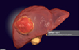 Liver Cancer